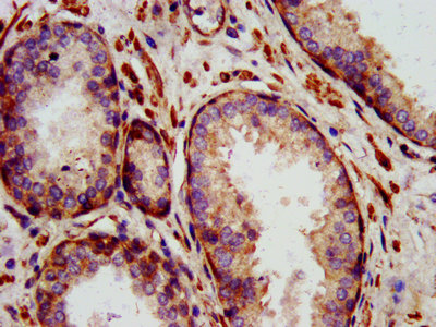 IL24 Antibody - IHC image of IL24 Antibody diluted at 1:1400 and staining in paraffin-embedded human prostate cancer performed on a Leica BondTM system. After dewaxing and hydration, antigen retrieval was mediated by high pressure in a citrate buffer (pH 6.0). Section was blocked with 10% normal goat serum 30min at RT. Then primary antibody (1% BSA) was incubated at 4°C overnight. The primary is detected by a biotinylated secondary antibody and visualized using an HRP conjugated SP system.