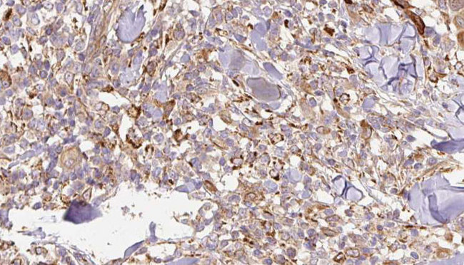 IL24 Antibody - 1:100 staining human Melanoma tissue by IHC-P. The sample was formaldehyde fixed and a heat mediated antigen retrieval step in citrate buffer was performed. The sample was then blocked and incubated with the antibody for 1.5 hours at 22°C. An HRP conjugated goat anti-rabbit antibody was used as the secondary.