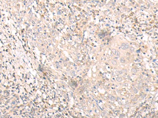 IL24 Antibody - Immunohistochemistry of paraffin-embedded Human cervical cancer tissue  using IL24 Polyclonal Antibody at dilution of 1:30(×200)