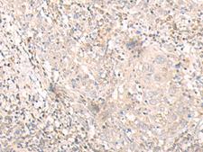 IL24 Antibody - Immunohistochemistry of paraffin-embedded Human cervical cancer tissue  using IL24 Polyclonal Antibody at dilution of 1:30(×200)