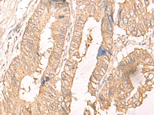 IL24 Antibody - Immunohistochemistry of paraffin-embedded Human colorectal cancer tissue  using IL24 Polyclonal Antibody at dilution of 1:30(×200)