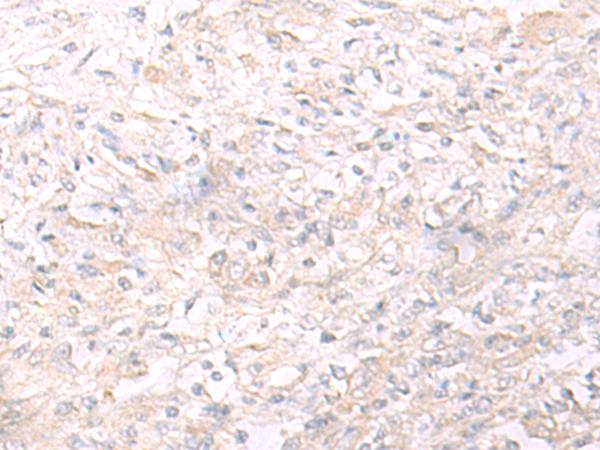 IL26 Antibody - Immunohistochemistry of paraffin-embedded Human liver cancer tissue  using IL26 Polyclonal Antibody at dilution of 1:65(×200)