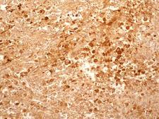 IL27RA Antibody - Immunohistochemistry-Paraffin: IL27RA Antibody (34N4G11) - IHC-P detection of IL27RA protein in a section of human renal/kidney cancer tissue using IL27RA antibody (34N4G11) at a concentration of 5ug/ml. The representative image shows membrane-cytoplasmic positivity for IL27RA protein in the cancer cells.  This image was taken for the unconjugated form of this product. Other forms have not been tested.