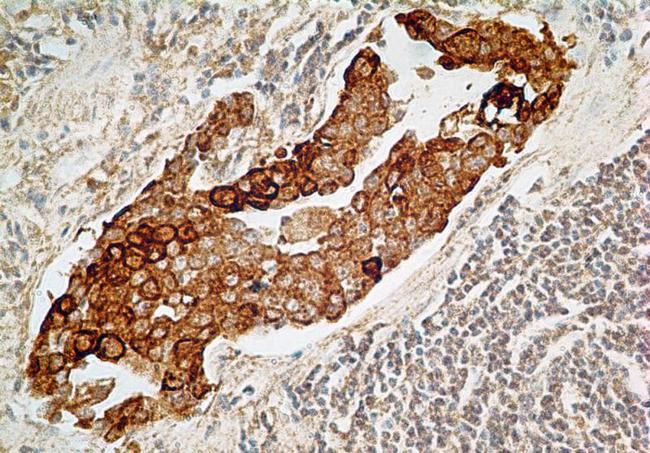 IL27RA Antibody - Immunohistochemistry-Paraffin: IL27RA Antibody (34N4G11) - Adenocarcinoma of the stomach probed with IL-27R antibody at 5 ug/ml.  This image was taken for the unconjugated form of this product. Other forms have not been tested.
