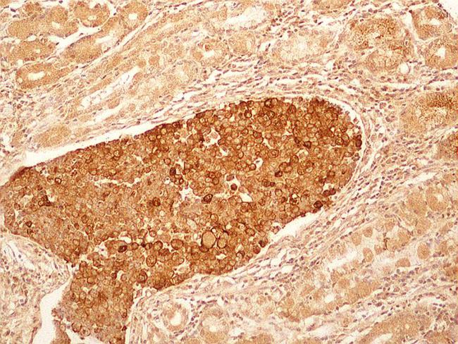 IL27RA Antibody - Immunohistochemistry-Paraffin: IL27RA Antibody (34N4G11) - IHC-P detection of IL27RA protein in a section of human stomach cancer tissue using IL27RA antibody (34N4G11) at a concentration of 5ug/ml. The cancer cells showed intense membrane-cytoplasmic positivity for IL27RA protein, whereas, the glands in adjacent area and the associated stroma developed distinctly weak staining.  This image was taken for the unconjugated form of this product. Other forms have not been tested.
