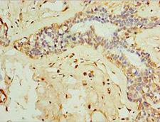 IL28B Antibody - Immunohistochemistry of paraffin-embedded human breast cancer using antibody at 1:100 dilution.