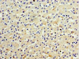 IL28B Antibody - Immunohistochemistry of paraffin-embedded human liver cancer using antibody at 1:100 dilution.