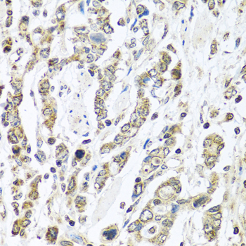 IL28B Antibody - Immunohistochemistry of paraffin-embedded human gastric cancer tissue.