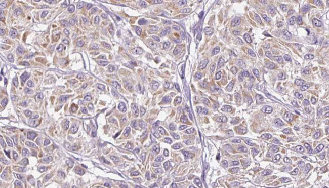 IL28B Antibody - 1:100 staining human Melanoma tissue by IHC-P. The sample was formaldehyde fixed and a heat mediated antigen retrieval step in citrate buffer was performed. The sample was then blocked and incubated with the antibody for 1.5 hours at 22°C. An HRP conjugated goat anti-rabbit antibody was used as the secondary.