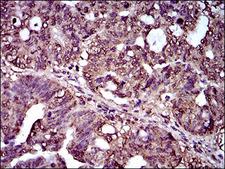 IL2RA / CD25 Antibody - IHC of paraffin-embedded rectum cancer tissues using IL2RA mouse monoclonal antibody with DAB staining.