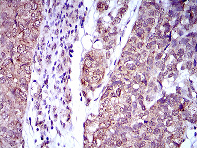 IL2RA / CD25 Antibody - IHC of paraffin-embedded bladder cancer tissues using IL2RA mouse monoclonal antibody with DAB staining.