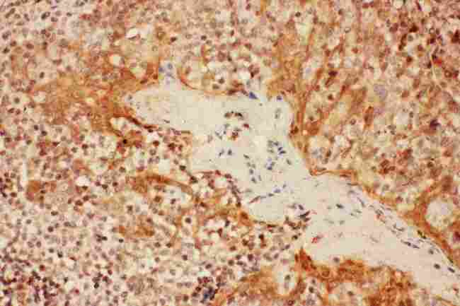 IL2RA / CD25 Antibody - anti-CD25/IL-2sR Alpha antibody, IHC(P): Human Tonsil Tissue