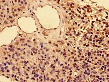 IL2RA / CD25 Antibody - Immunohistochemistry image of paraffin-embedded human glioma cancer at a dilution of 1:100