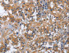 IL2RB / CD122 Antibody - Immunohistochemistry of paraffin-embedded Human thyroid cancer using IL2RB Polyclonal Antibody at dilution of 1:30.