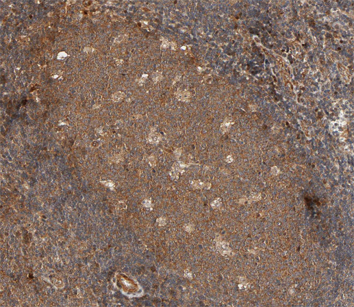 IL2RB / CD122 Antibody - 1:100 staining human lymphoma tissue by IHC-P. The tissue was formaldehyde fixed and a heat mediated antigen retrieval step in citrate buffer was performed. The tissue was then blocked and incubated with the antibody for 1.5 hours at 22°C. An HRP conjugated goat anti-rabbit antibody was used as the secondary.