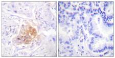 IL2RB / CD122 Antibody - Peptide - + Immunohistochemistry analysis of paraffin-embedded human lung carcinoma tissue using IL-2Rß/CD122 (Ab-364) antibody.