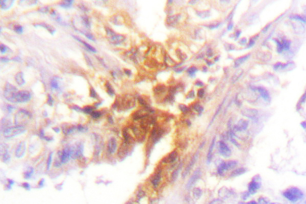 IL2RB / CD122 Antibody - IHC of IL-2R (T360) pAb in paraffin-embedded human lung carcinoma tissue.