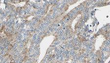 IL2RG / CD132 Antibody - 1:100 staining human prostate tissue by IHC-P. The sample was formaldehyde fixed and a heat mediated antigen retrieval step in citrate buffer was performed. The sample was then blocked and incubated with the antibody for 1.5 hours at 22°C. An HRP conjugated goat anti-rabbit antibody was used as the secondary.