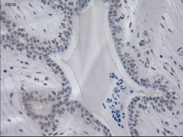 IL3 Antibody - Immunohistochemical staining of paraffin-embedded breast using anti-IL-3 mouse monoclonal antibody.