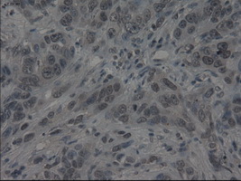 IL3 Antibody - Immunohistochemical staining of paraffin-embedded Adenocarcinoma of breast using anti-IL-3 mouse monoclonal antibody.