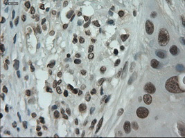 IL3 Antibody - Immunohistochemical staining of paraffin-embedded Carcinoma of lung using anti-IL-3 mouse monoclonal antibody.