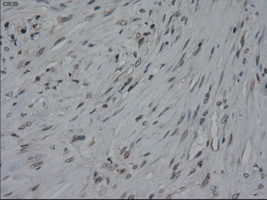 IL3 Antibody - Immunohistochemical staining of paraffin-embedded Carcinoma of pancreas using anti-ZERO mouse monoclonal antibody.