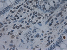 IL3 Antibody - Immunohistochemical staining of paraffin-embedded colon using anti-IL-3 mouse monoclonal antibody.