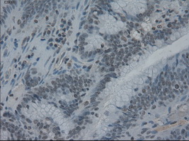 IL3 Antibody - Immunohistochemical staining of paraffin-embedded Adenocarcinoma of endometrium using anti-ZERO mouse monoclonal antibody.