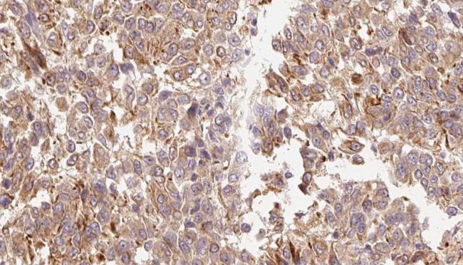 IL3 Antibody - 1:100 staining human Melanoma tissue by IHC-P. The sample was formaldehyde fixed and a heat mediated antigen retrieval step in citrate buffer was performed. The sample was then blocked and incubated with the antibody for 1.5 hours at 22°C. An HRP conjugated goat anti-rabbit antibody was used as the secondary.