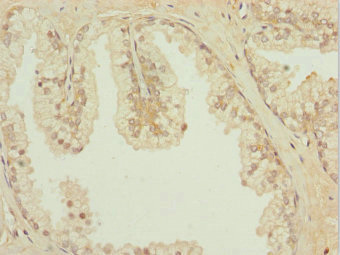 IL31RA Antibody - Immunohistochemistry of paraffin-embedded human prostata cancer at dilution 1:100