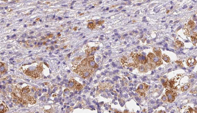 IL31RA Antibody - 1:100 staining human liver carcinoma tissues by IHC-P. The sample was formaldehyde fixed and a heat mediated antigen retrieval step in citrate buffer was performed. The sample was then blocked and incubated with the antibody for 1.5 hours at 22°C. An HRP conjugated goat anti-rabbit antibody was used as the secondary.