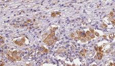 IL31RA Antibody - 1:100 staining human liver carcinoma tissues by IHC-P. The sample was formaldehyde fixed and a heat mediated antigen retrieval step in citrate buffer was performed. The sample was then blocked and incubated with the antibody for 1.5 hours at 22°C. An HRP conjugated goat anti-rabbit antibody was used as the secondary.