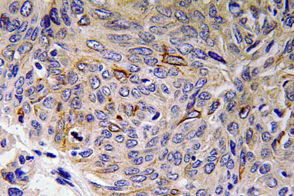 IL32 Antibody - Immunohistochemistry analysis of IL-32 antibody in paraffin-embedded human lung carcinoma tissue.