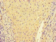 IL32 Antibody - Immunohistochemistry of paraffin-embedded human liver cancer at dilution of 1:100