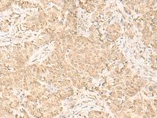 IL32 Antibody - Immunohistochemistry of paraffin-embedded Human ovarian cancer tissue  using IL32 Polyclonal Antibody at dilution of 1:45(×200)