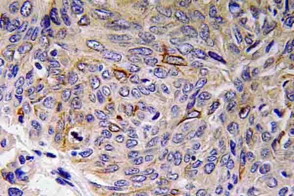 IL32 Antibody - IHC of IL-32 (K226) pAb in paraffin-embedded human lung carcinoma tissue.