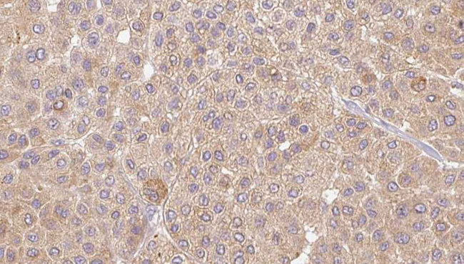 IL36A Antibody - 1:100 staining human Melanoma tissue by IHC-P. The sample was formaldehyde fixed and a heat mediated antigen retrieval step in citrate buffer was performed. The sample was then blocked and incubated with the antibody for 1.5 hours at 22°C. An HRP conjugated goat anti-rabbit antibody was used as the secondary.