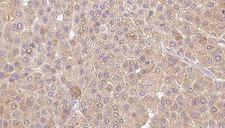 IL36A Antibody - 1:100 staining human Melanoma tissue by IHC-P. The sample was formaldehyde fixed and a heat mediated antigen retrieval step in citrate buffer was performed. The sample was then blocked and incubated with the antibody for 1.5 hours at 22°C. An HRP conjugated goat anti-rabbit antibody was used as the secondary.