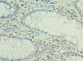 IL36RN / IL1F5 Antibody - Immunohistochemistry of paraffin-embedded human colon cancer using antibody at 1:100 dilution.