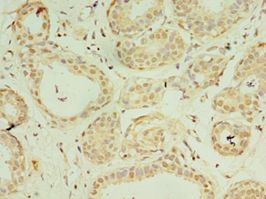IL37 Antibody - Immunohistochemistry of paraffin-embedded human breast cancer using antibody at 1:100 dilution.