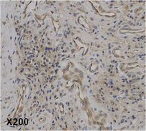 IL37 Antibody - Immunohistochemical staining of IL-37 in human rheumatoid arthritis tissue. . Method: Immunohistochemical analysis of a paraffin-embedded rheumatoid arthritis tissue, showing endothelial cells and plasma cells (mature B cells) stained by anti-IL-37 at dilution 1:50 (under X200 lens, Brown color).