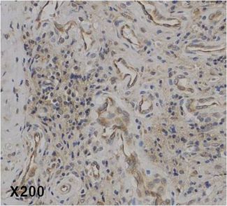 IL37 Antibody - Immunohistochemical staining of IL-37 in human rheumatoid arthritis tissue. . Method: Immunohistochemical analysis of a paraffin-embedded rheumatoid arthritis tissue, showing endothelial cells and plasma cells (mature B cells) stained by anti-IL-37 at dilution 1:50 (under X200 lens, Brown color).