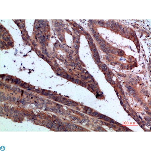 IL37 Antibody - Immunohistochemical analysis of paraffin-embedded human-colon-cancer, antibody was diluted at 1:200.