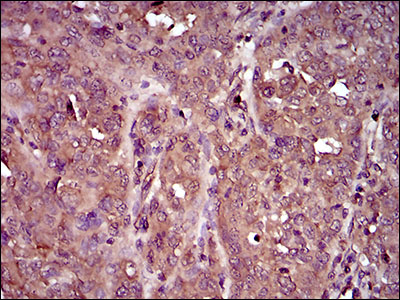 IL3RA / CD123 Antibody - IHC of paraffin-embedded ovarian cancer tissues using IL3RA mouse monoclonal antibody with DAB staining.