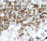 IL3RA / CD123 Antibody - IHC of CD123 on FFPE Kikuchi-Fujimoto Disease tissue. This image was taken for the unmodified form of this product. Other forms have not been tested.