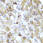 IL4 Antibody - Immunohistochemistry of paraffin-embedded human liver injury tissue.
