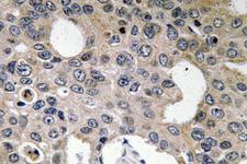 IL4R / CD124 Antibody - Immunohistochemistry analysis of IL-4RÎ± antibody in paraffin-embedded human breast carcinoma tissue.