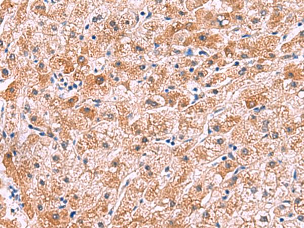 IL4R / CD124 Antibody - Immunohistochemistry of paraffin-embedded Human liver cancer tissue  using IL4R Polyclonal Antibody at dilution of 1:45(×200)
