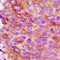 IL5 Antibody - Immunohistochemical analysis of IL-5 staining in human breast cancer formalin fixed paraffin embedded tissue section. The section was pre-treated using heat mediated antigen retrieval with sodium citrate buffer (pH 6.0). The section was then incubated with the antibody at room temperature and detected using an HRP conjugated compact polymer system. DAB was used as the chromogen. The section was then counterstained with hematoxylin and mounted with DPX.
