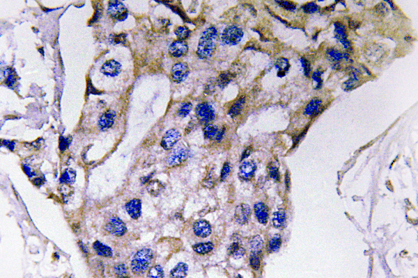 IL5 Antibody - IHC of IL-5 (S92) pAb in paraffin-embedded human breast carcinoma tissue.